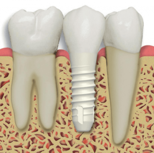 ©Centreforadvancedperiodontalanddentalimplanttherapy